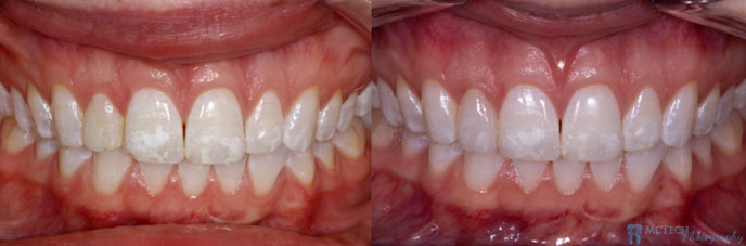Expanded Smile Before And After